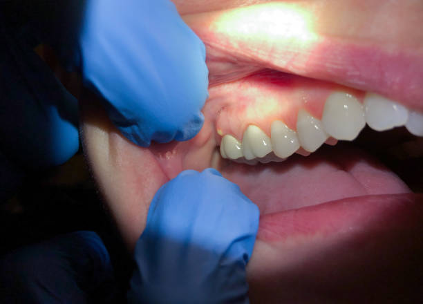 Best Emergency Treatment for Dental Infections or Abscesses in Fulshear, TX